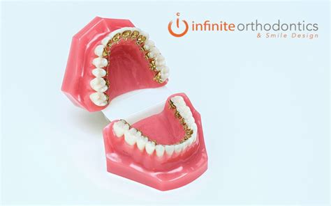 Incognito Braces In Plano Tx In Plano Tx Infinite Orthodontics