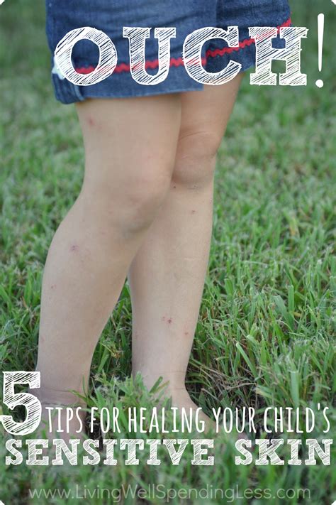 Ouch 5 Tips For Healing Your Childs Sensitive Skin Got