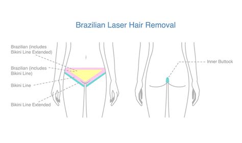 Does Brazilian Laser Hair Removal Get Rid Of Hair Permanently