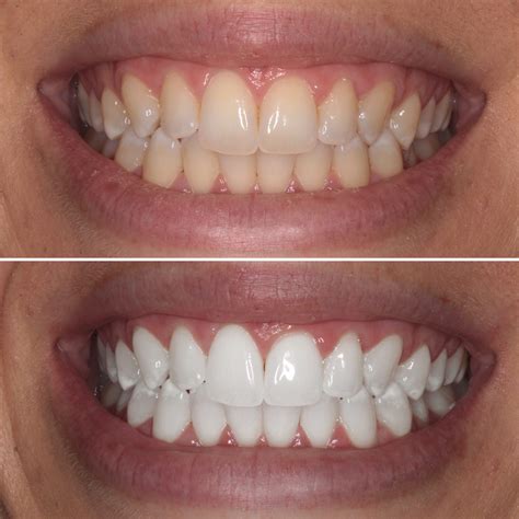 This article show you how to whiten teeth and keep them healthy at home without seeing a dentist. Teeth Whitening Sydney | Dental Lounge