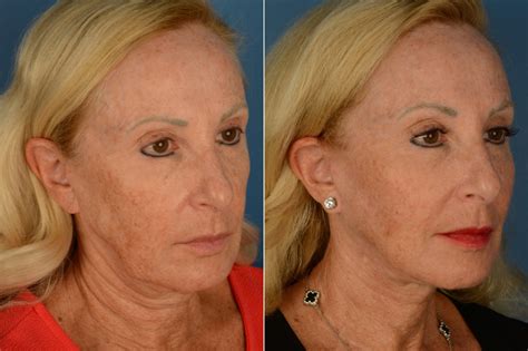 The Uplift™ Lower Face And Neck Lift Photos Naples Fl Patient 19731