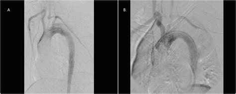 Type Ii Endoleak After Emergent Carotid Subclavian Bypass Surgery In