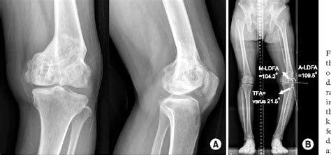 Figure 1 From Deformity Correction By Femoral Supracondylar Dome