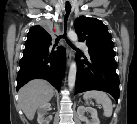 Lung Mass Ct Scan Wikidoc