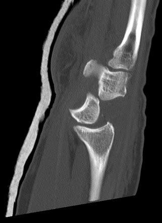 Perilunate Dislocation Radiology Case Radiopaedia Org