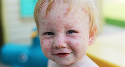 The varicella vaccine, commonly known as the chickenpox vaccine is a shot that protects young children and adults from catching chicken pox, a. The chicken pox vaccine | BabyCenter