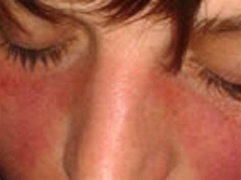 Systemic Lupus Erythematosus Causes Symptoms And Treatment