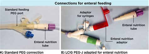 J Peg Tube