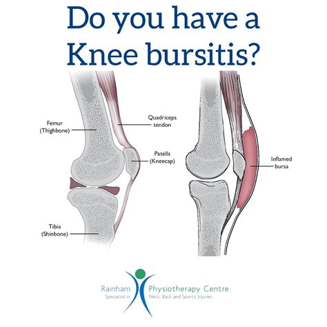 Do You Have A Knee Bursitis Rainham Physio