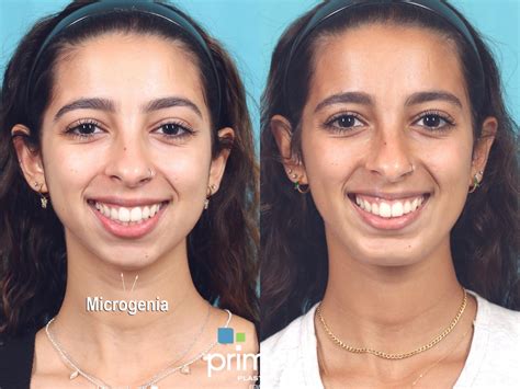 Chin And Cheek Implant Before And After Pictures Case 914 Orlando