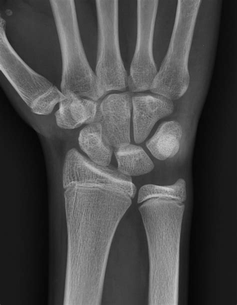 Tenosynovitis Wrist Image