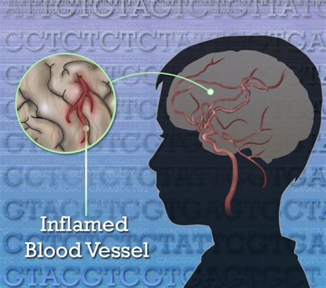Rare Disease Sleuths Uncover New Clues to Stroke – NIH Director's Blog