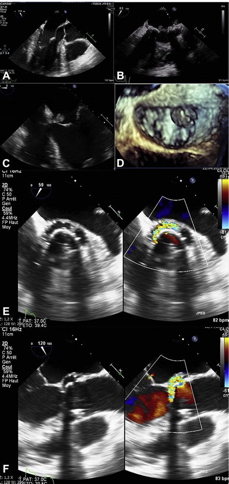 Echocardiographic Findings In Mitral Valve Endocarditis A Normal
