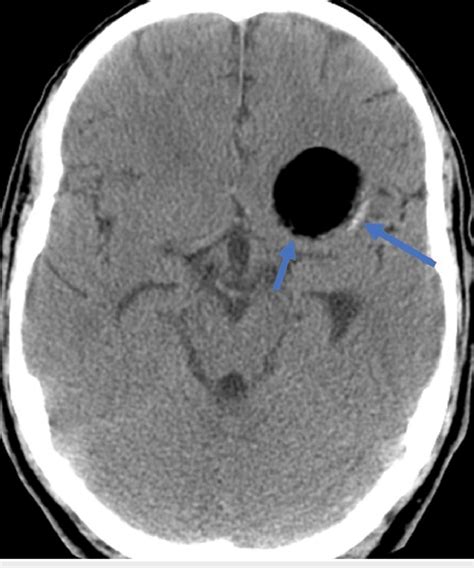 Brain Ct Revealing A Hypodense Lesion With Smooth Margins Having Cystic