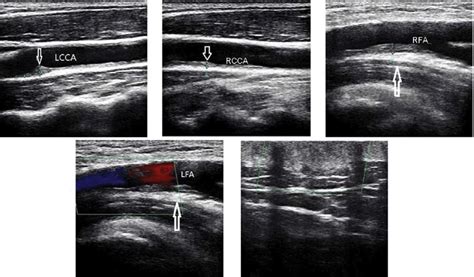 Carotid Artery Doppler Ultrasound