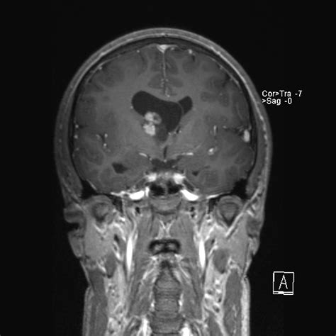 Subependymal Giant Cell Astrocytoma Pacs