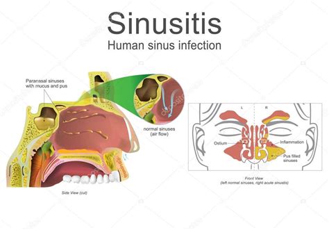 Sinusitis Humana Inflamación Ilustración Arte Vectorial 2023