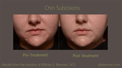 View The Before And After Gallery For Chin Subcisions From Real