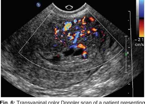 Figure 6 From Ultrasound Imaging Of Gestational Trophoblastic Disease