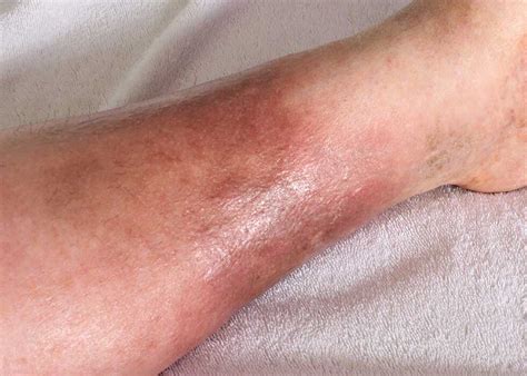 Cellulitis Treatment Dermatology Inc