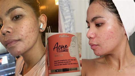 Kallistia Acne Cleanse Skin Care For 30 Days Honest Review Hormonal