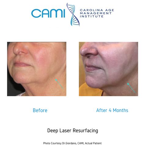 Laser Face Lift Before And After Photos Book A Free Consultation