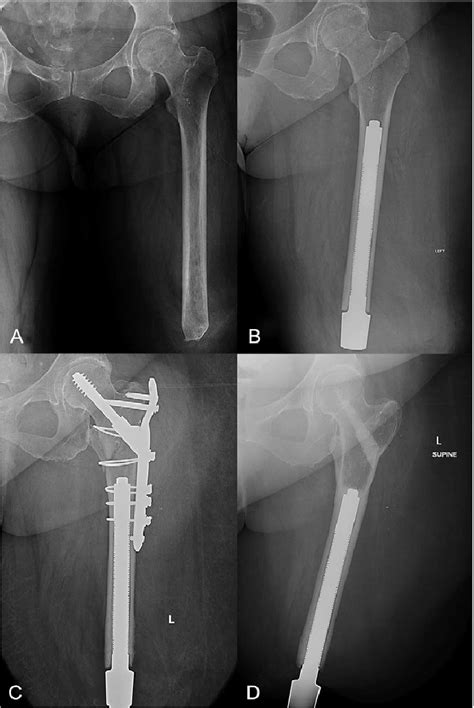 Radiographs Of A Transfemoral Amputee Whom Went Through Osseointegrated