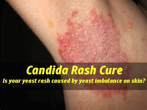 Candida Rashes Is Your Yeast Rash Caused By Yeast Imbalance On Skin