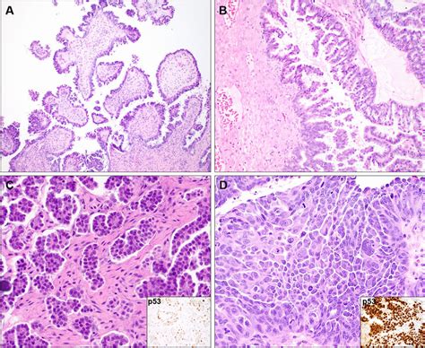 Histopathologic Spectrum Of Ovarian Serous Tumors A Serous Borderline