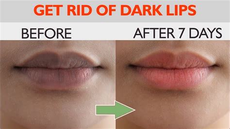 How To Remove Darkness From Lips Forever Lighten Your Lips Naturally