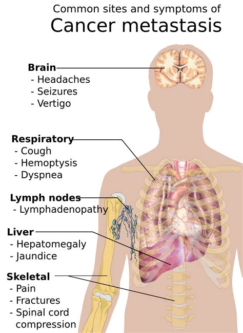 Signs And Symptoms Of Cancer Wikipedia