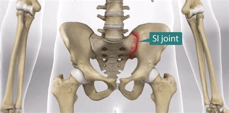 Si Joint What Does An Si Joint Look Like Florida Surgery Consultants