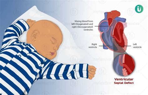 Congenital Heart Disease Defect Symptoms Causes Treatment