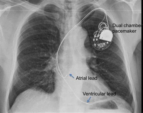 But they can affect how an icd performs. Dual chamber pacemaker - Chest X-ray - both atrial and ...