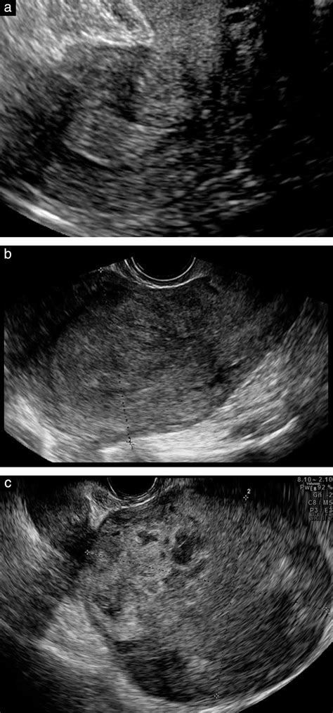 Grayscale And Color Doppler Ultrasound Characteristics Of Endometrial