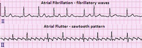 Flutter Vs Atrial Fibrillation EKG
