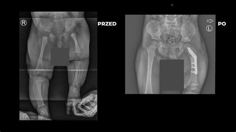 Congenital Femoral Deficiency Proximal Femoral Focal Deficiency Paley