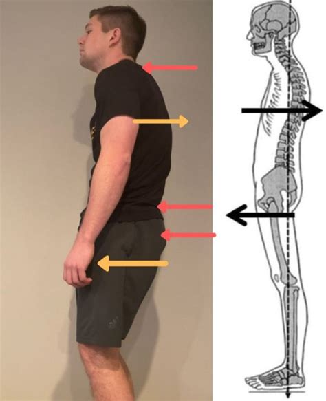 Swayback Posture With Posterior Compression Progress Posture