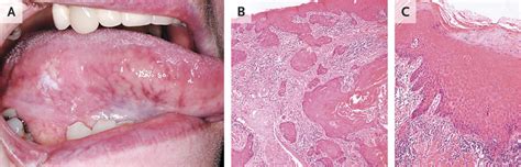 Squamous Cell Carcinoma Of The Tongue Nejm