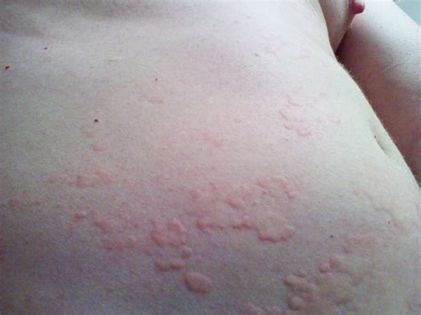 Allergic Reaction Rash To Laundry Detergent Causes Symptoms And Treatment Martlabpro
