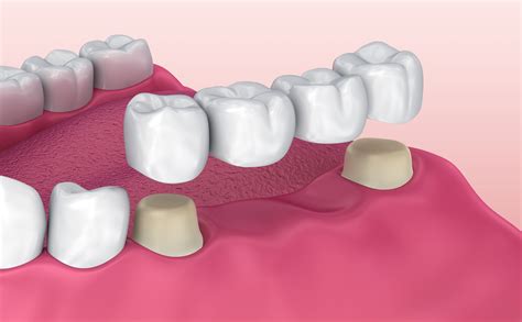 History Of Dental Bridges Canton Oh Restorative Dentistry Innovations