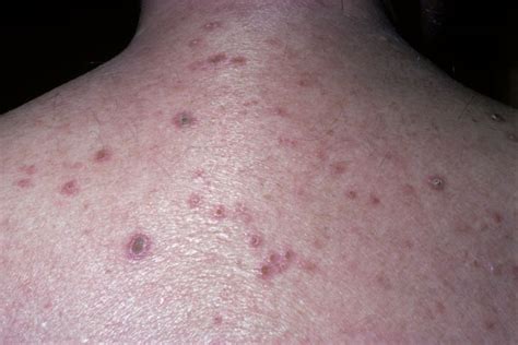 Derm Dx An Elderly Man With Multiple Intensely Itchy Dark Red Bumps Clinical Advisor