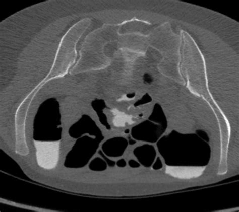 Clinical Case Chronic Constipation And Abdominal Pain