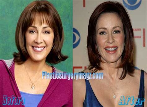 Patricia Heaton Plastic Surgery Before And After Plastic Surgery Magazine