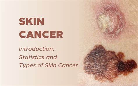 Skin Cancer Introduction Statistics And Types Of Skin Cancer
