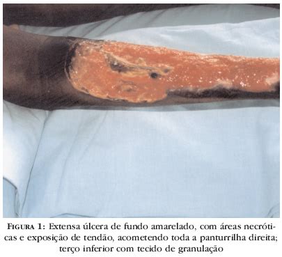 We did not find results for: Martorell's hypertensive ulcer: case report