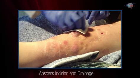 Wcw Abscess Incision And Drainage Youtube