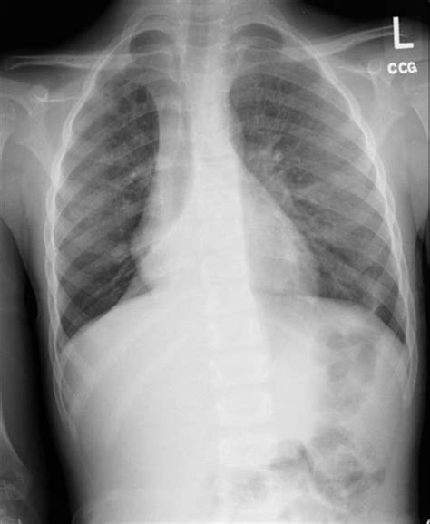 Atelectasis Chest X Ray Wikidoc Lung Lobes Medical Therapy