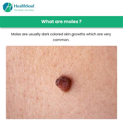 List 98 Pictures Anatomy Of A Mole On The Skin Updated