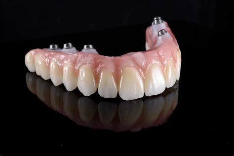 Dental Implant Hybrid Restorations Burbank Dental Lab